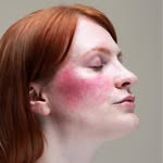 Lex Gillies - Rosacea + Skin Positivity profile photo
